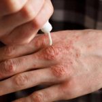 Alerta in Romania Primul caz de lepra dupa 44 de ani