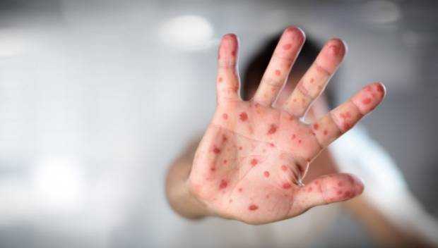 Criza vaccinarii scapa de sub control Romania conduce statisticile rujeolei in Europa