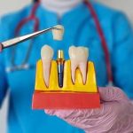 Implant dentar versus punte dentara Care este cea mai buna alegere