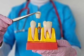 Implant dentar versus punte dentara Care este cea mai buna alegere