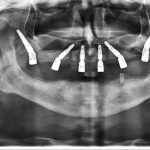 Dr Vlad Negru si echipa de la Dentalix inoveaza implantologia din Romania De la niciun dinte la o arcada completa in doar 60 de minute