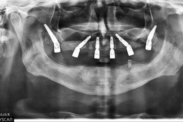 Dr Vlad Negru si echipa de la Dentalix inoveaza implantologia din Romania De la niciun dinte la o arcada completa in doar 60 de minute