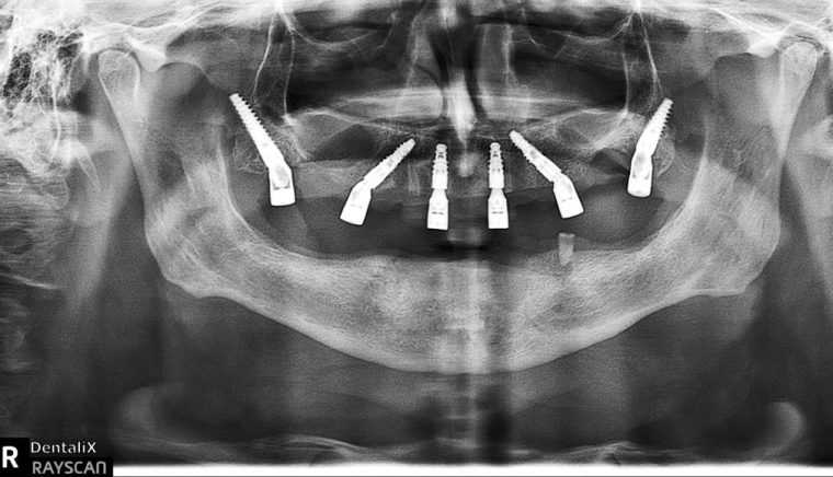 Dr Vlad Negru si echipa de la Dentalix inoveaza implantologia din Romania De la niciun dinte la o arcada completa in doar 60 de minute